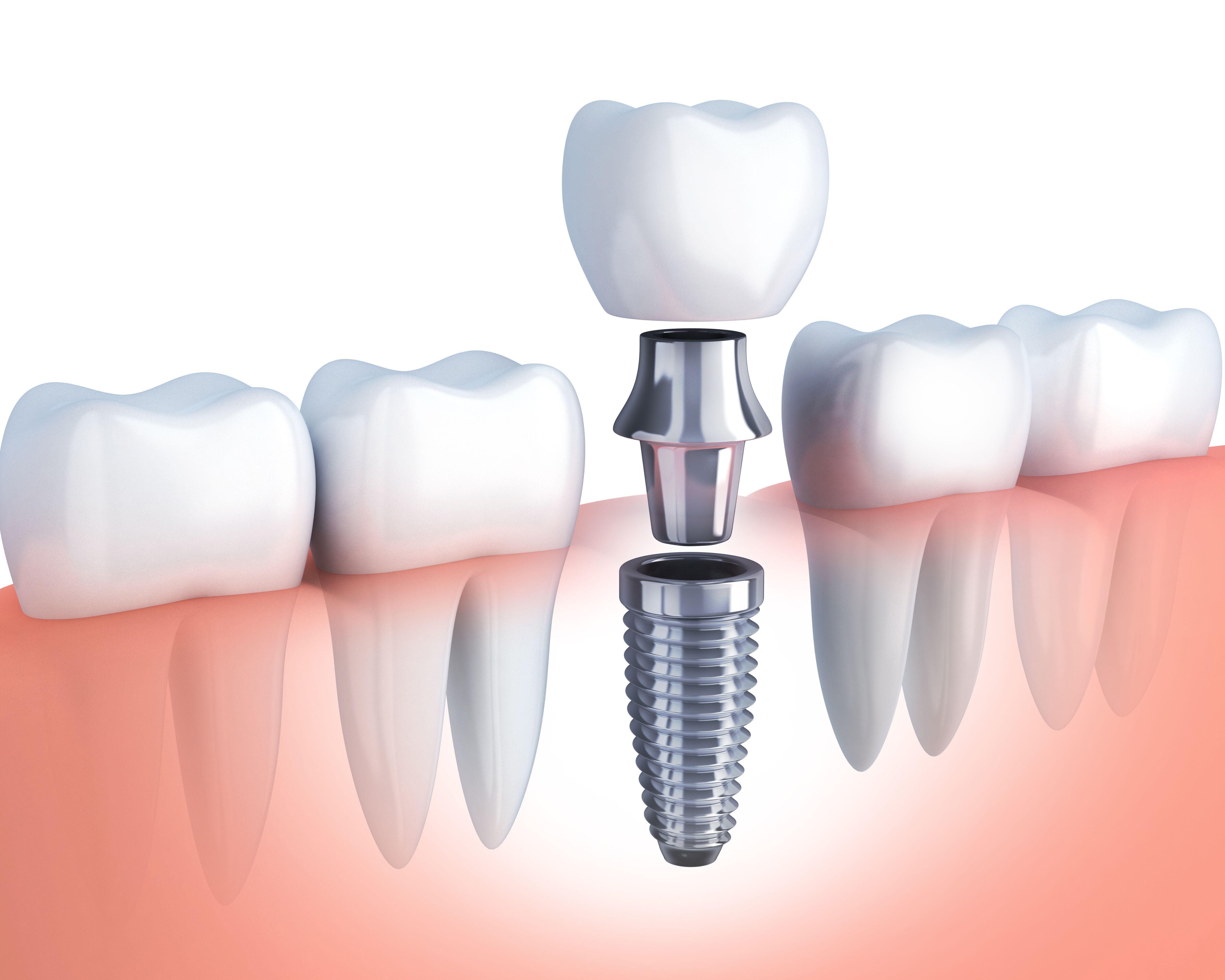 Dental implant restoration at Maggie A. Kleem, DDS in Berea, Ohio